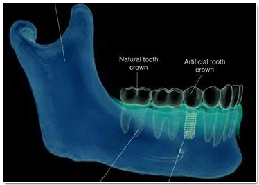 Implant surgery