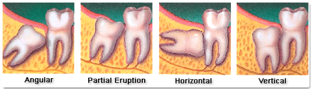 Extraction Indications of Impacted Teeth