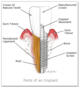 Dental implants